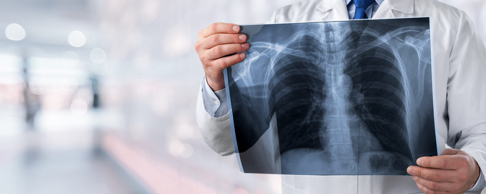 This is an image of a doctor holding a pleural mesothelioma scan.