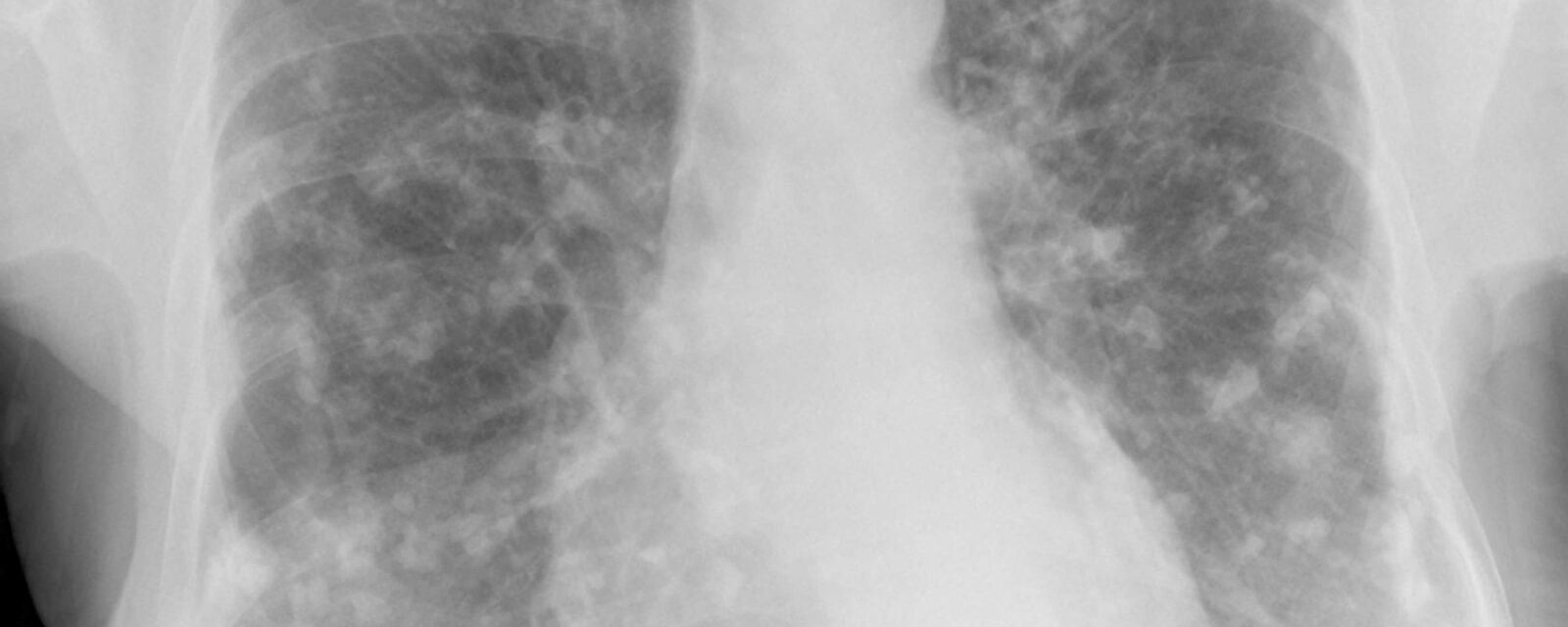 Photo of x-ray showing pleural plaques.