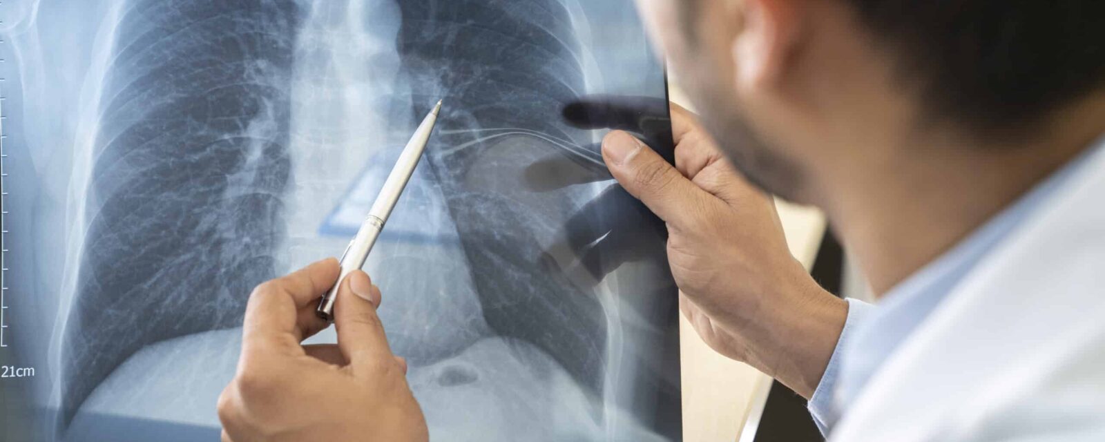 Mesothelioma pulmonologist reads x-ray of lungs.