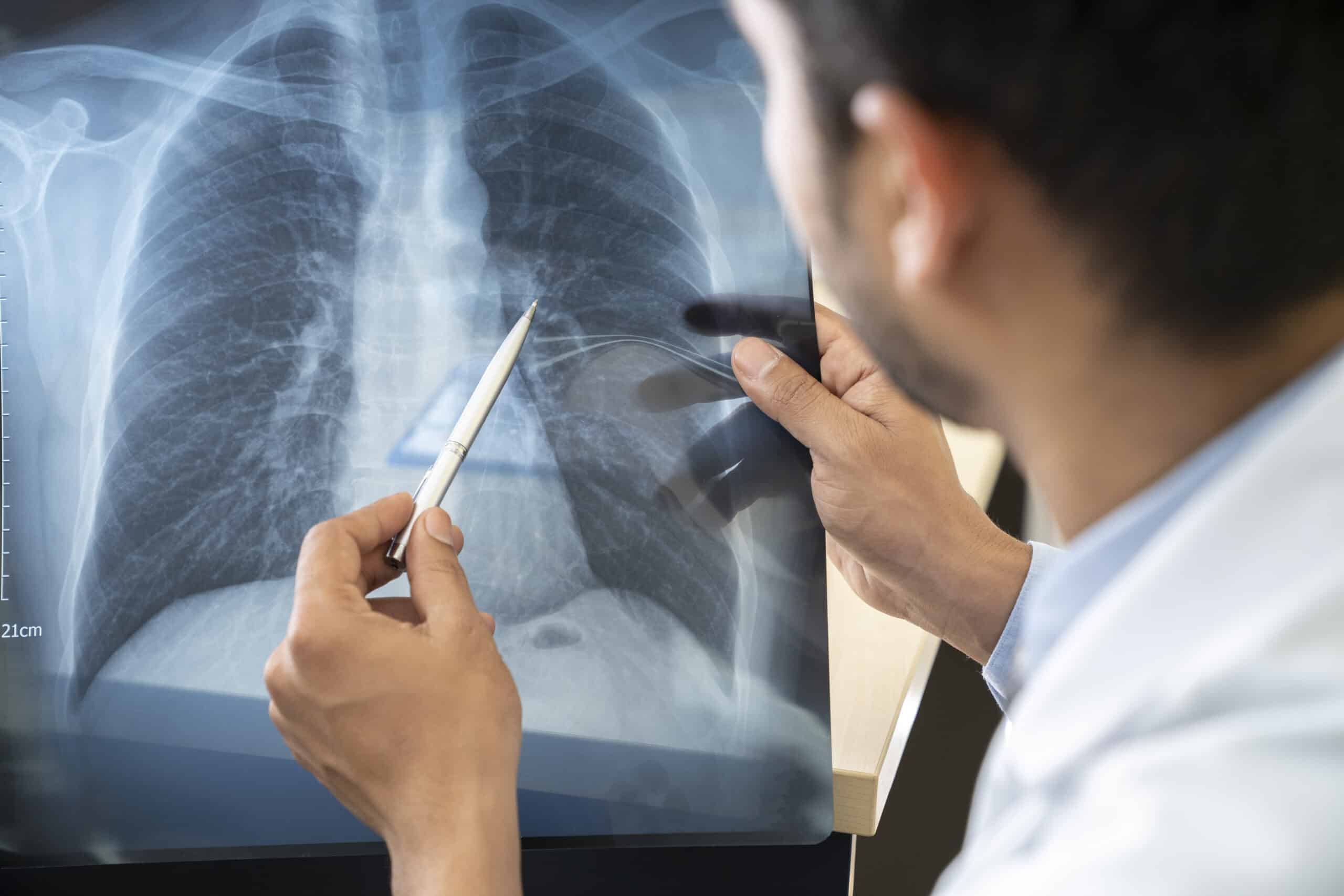 Mesothelioma pulmonologist reads x-ray of lungs.