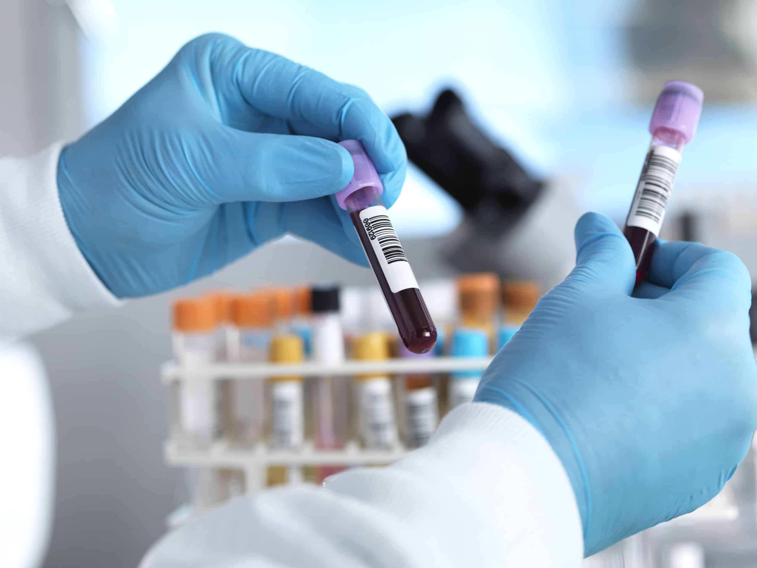 Lab worker holds blood test for mesothelioma.