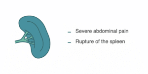 cancer spread symptoms to spleen
