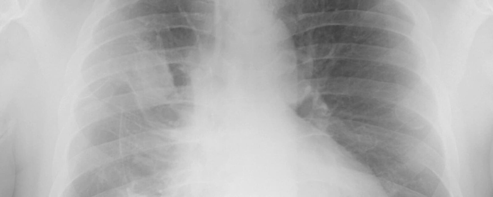 Digital x-ray image showing epithelioid mesothelioma cells.