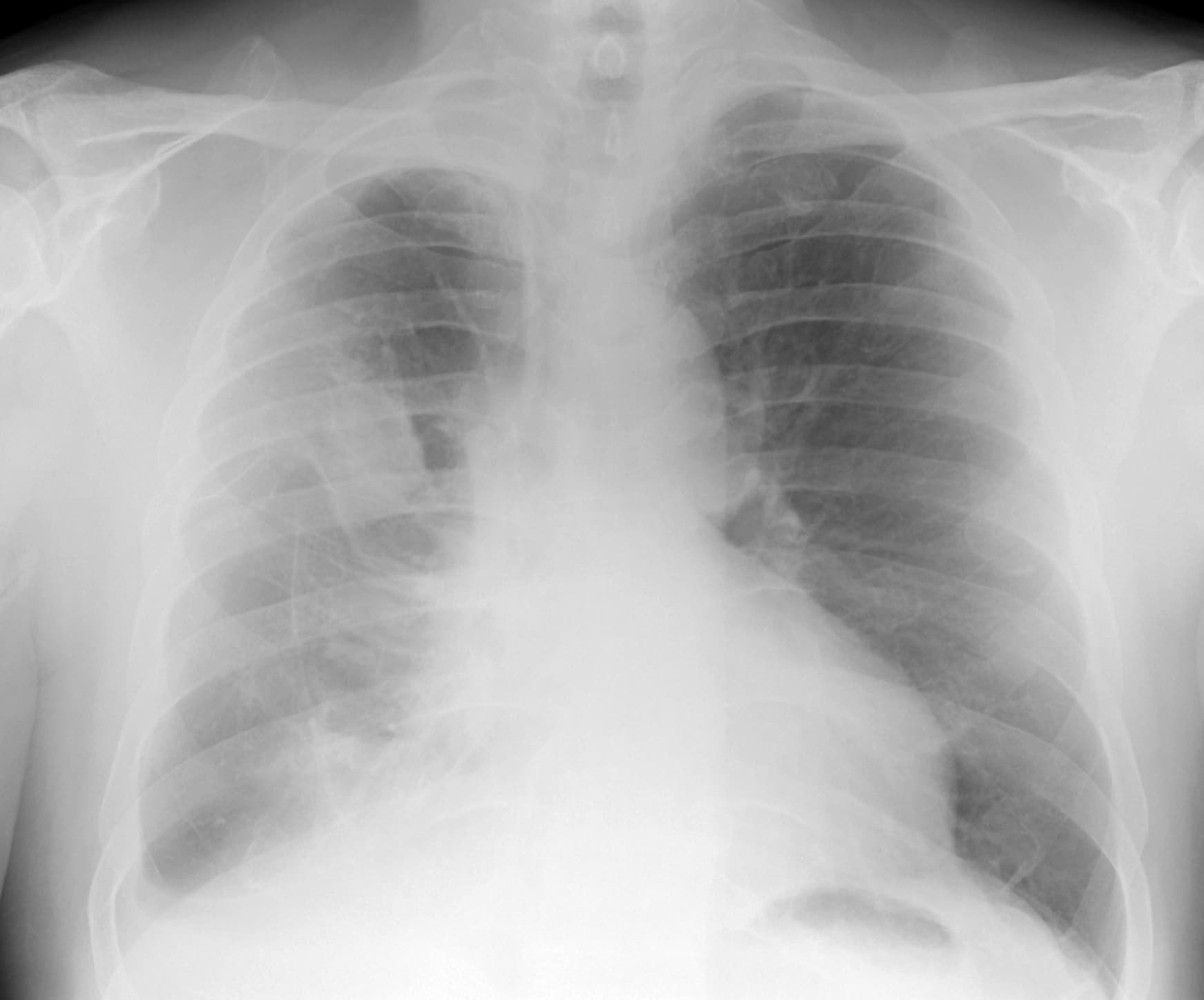 Digital x-ray image showing epithelioid mesothelioma cells.