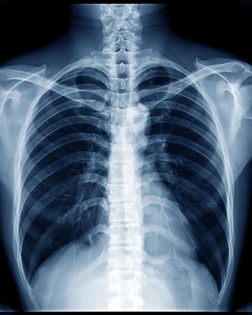A chest X-ray showing the healthy lungs of a person.