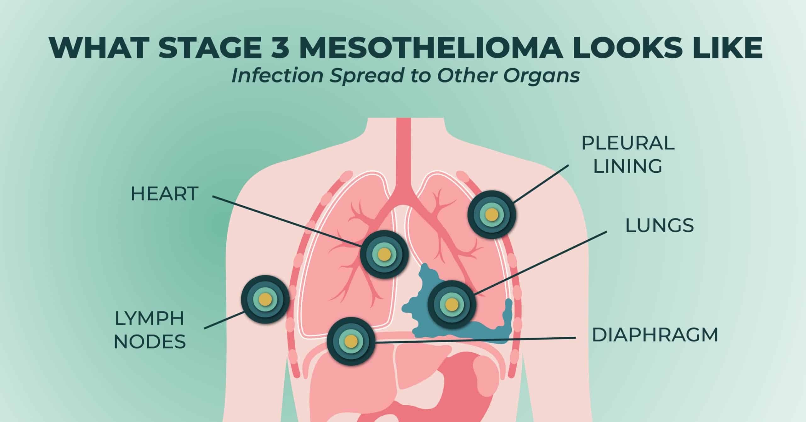 What stage 3 mesothelioma looks like inside the body.