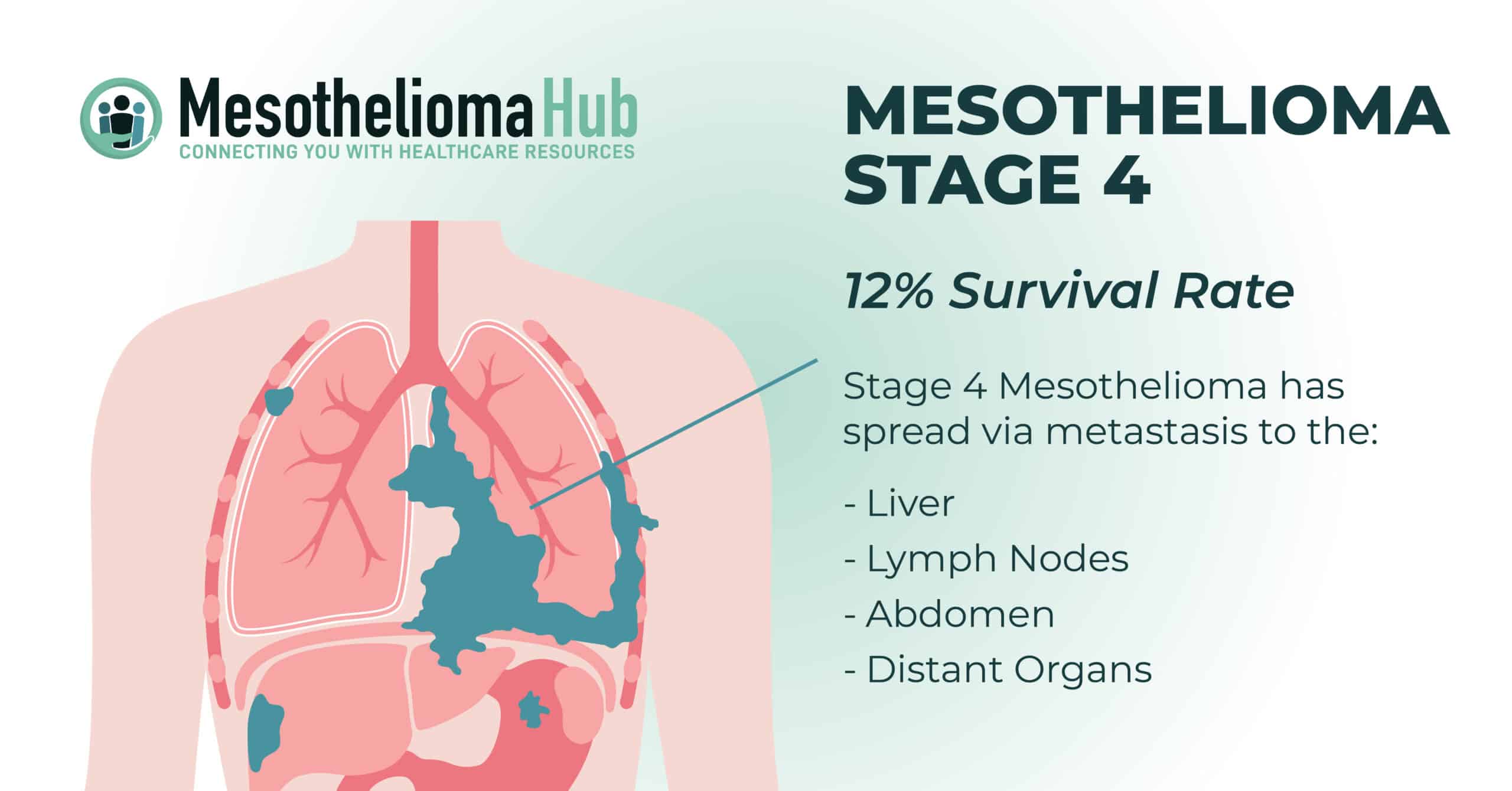 Infographic showing how mesothelioma stage 4 metastasizes in the liver, lymph nodes, abdomen, and distant organs and has a 12% survival rate.