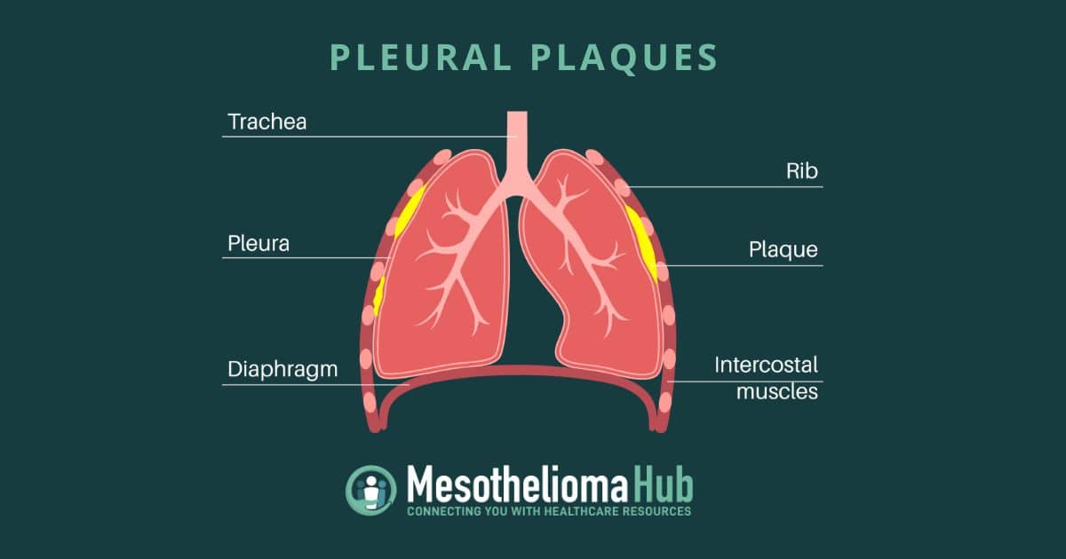 Pleural Plaques Infographic showing the different parts of the lung including the pleural and plaques.