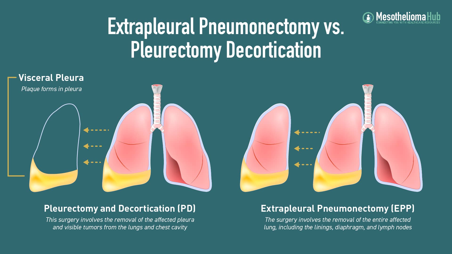 Extrapleural Pneumonectomy vs. Pleurectomy Decortication infographic showing the differences in the lungs.