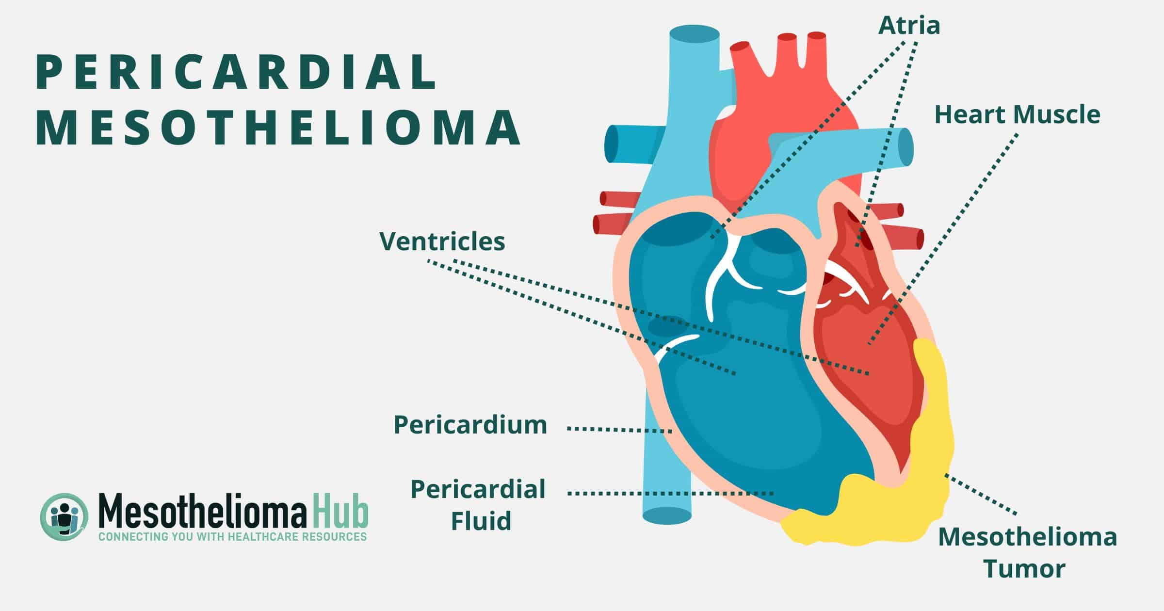 Pericardial Mesothelioma infographic showing the heart muscle, mesothelioma tumor, pericardium, ventricles, pericardial fluid, and atria.