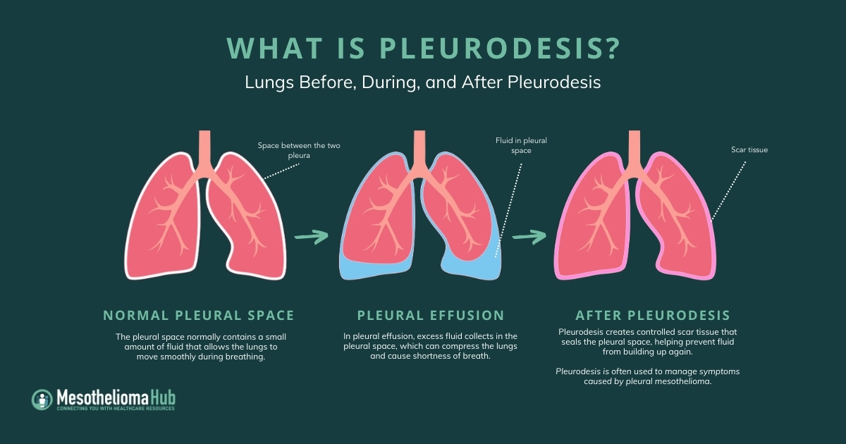 Infographic showing what is pluerodesis: Visual 1 — Normal Lungs: Illustration of healthy lungs showing the small space between the two pleural layers. Visual 2 — Pleural Effusion: Illustration showing fluid buildup between the lung and chest wall lining. Visual 3 — After Pleurodesis: Illustration showing the lung attached to the chest wall with the pleural space closed.