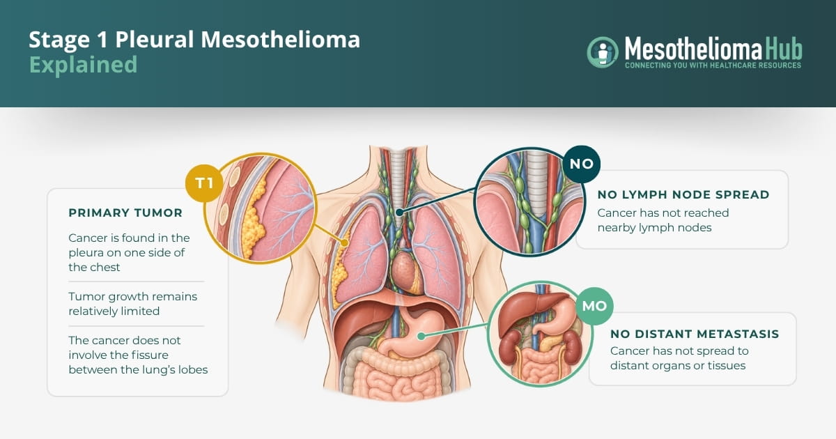 Infographic explaining stage 1 pleural mesothelioma as cancer limited to the pleura without lymph node involvement or distant spread.